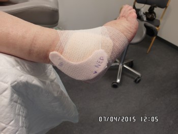 sår bag malleolen med pelotte.JPG